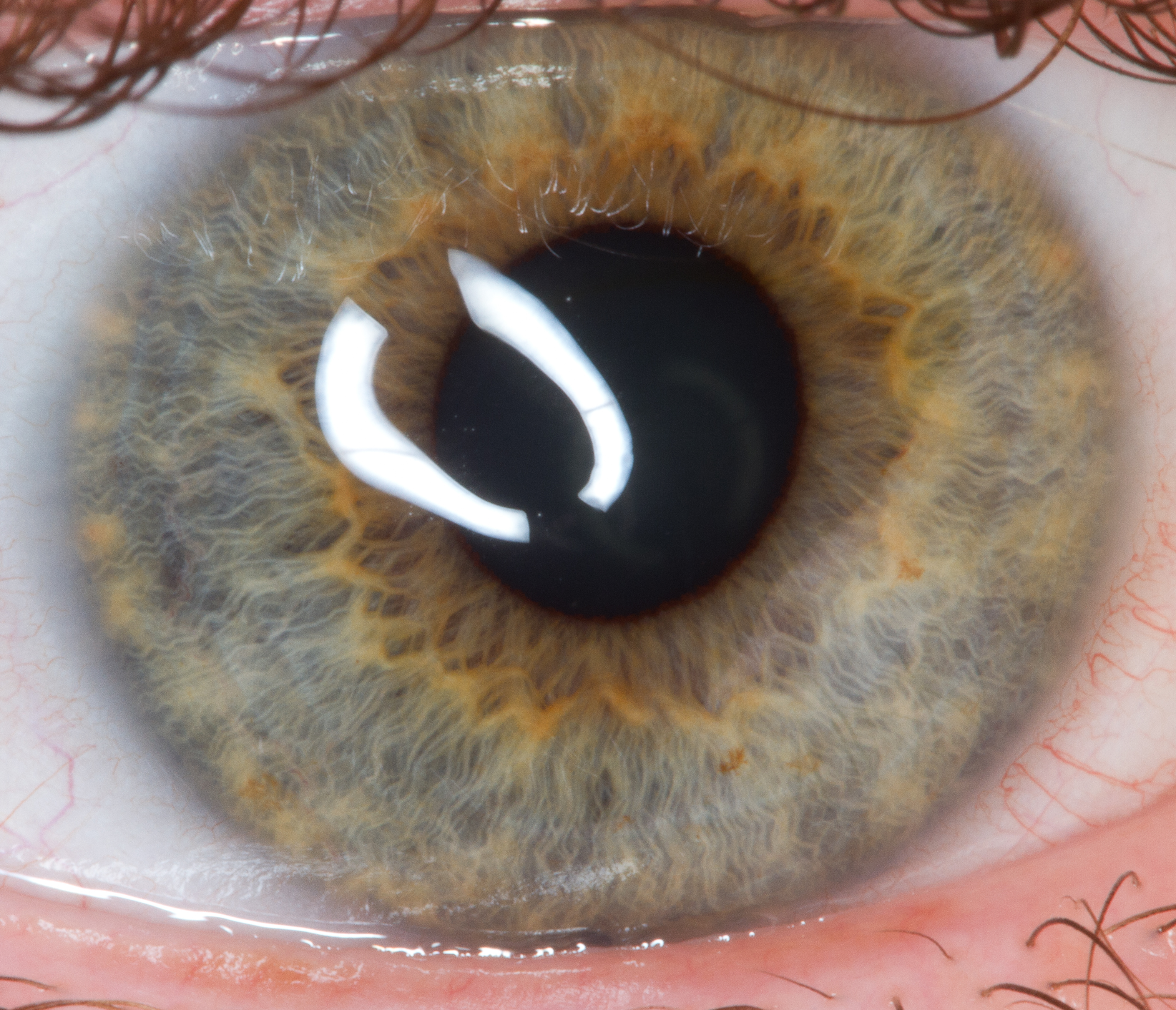 I just had a cornea transpant, stiches in the eye :(